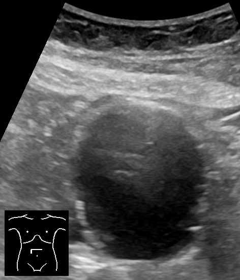 Abdominal aortic aneurysm with mural thrombus (axial) — Cross-section of an aortic aneurysm. Grey thrombus lines the wall and the black flowing lumen is smaller than the vessel.