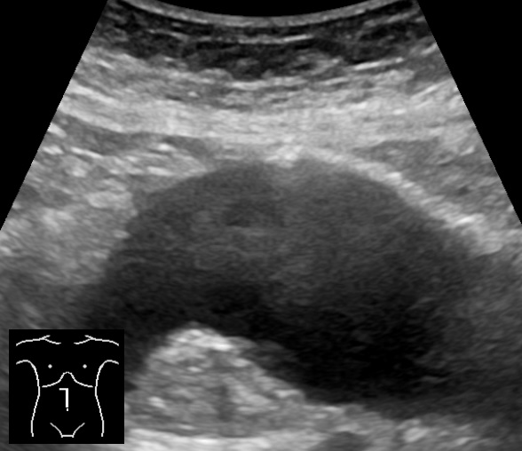 Abdominal aortic aneurysm (sagittal) — A markedly widened abdominal aorta (aneurysm) seen along its length.