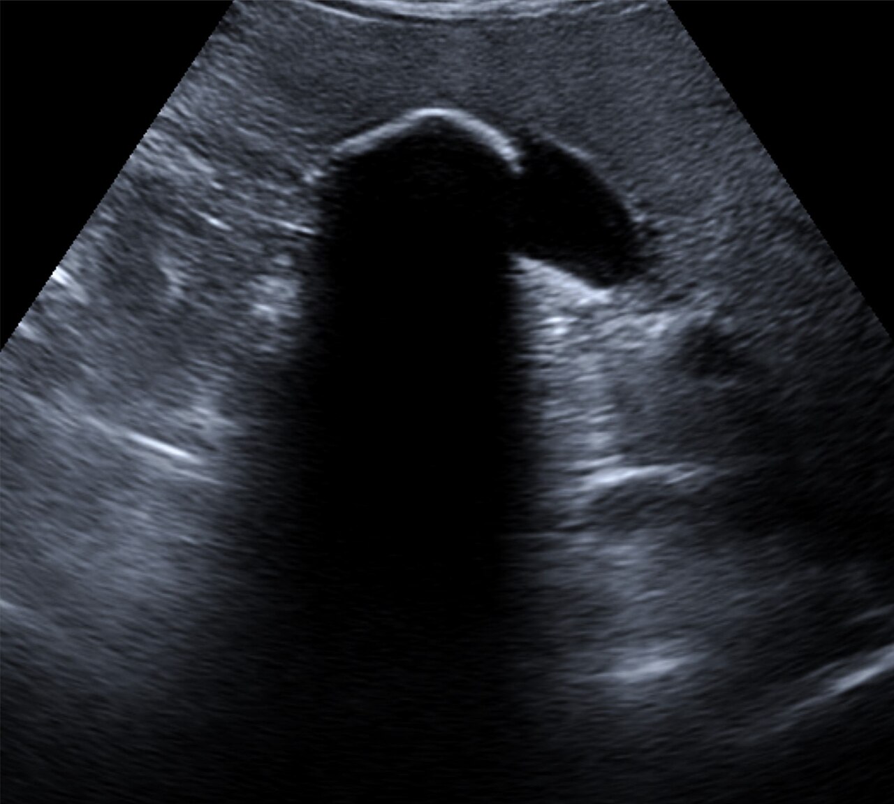 Acoustic shadowing from a gallstone — A large calcified gallstone blocks the sound beam, leaving a black shadow behind it.