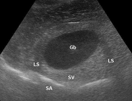 Edge (lateral) shadowing and enhancement — Labels in the image: Gb = gallbladder, LS = lateral (edge) shadows from the curved walls, SV = enhancement behind the gallbladder, SA = shadowing. German labels are burned in.