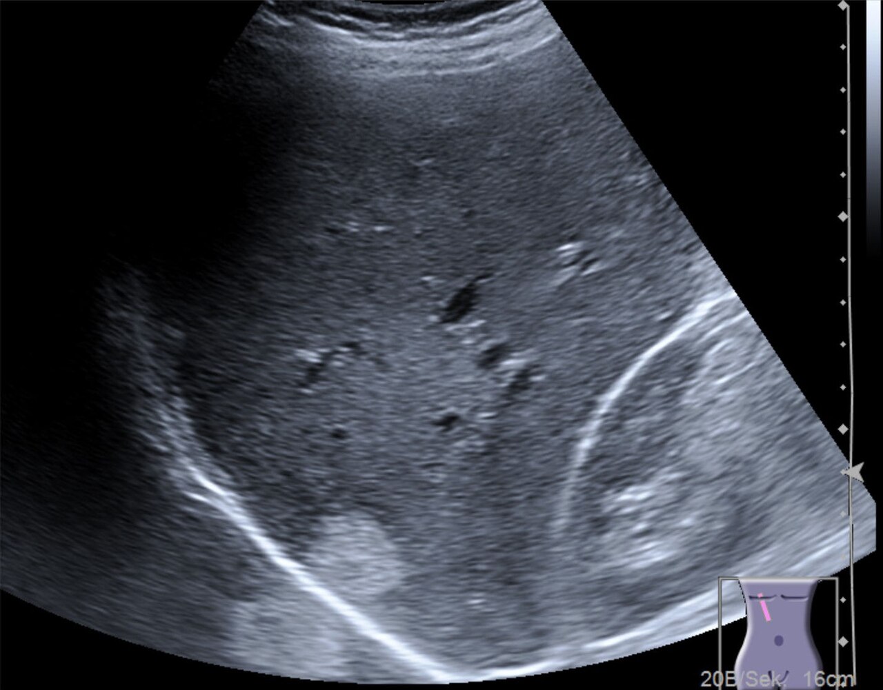 Mirror-image artifact across the diaphragm — An echogenic liver haemangioma near the diaphragm is copied as a false 'mirror' image that seems to lie outside the liver.