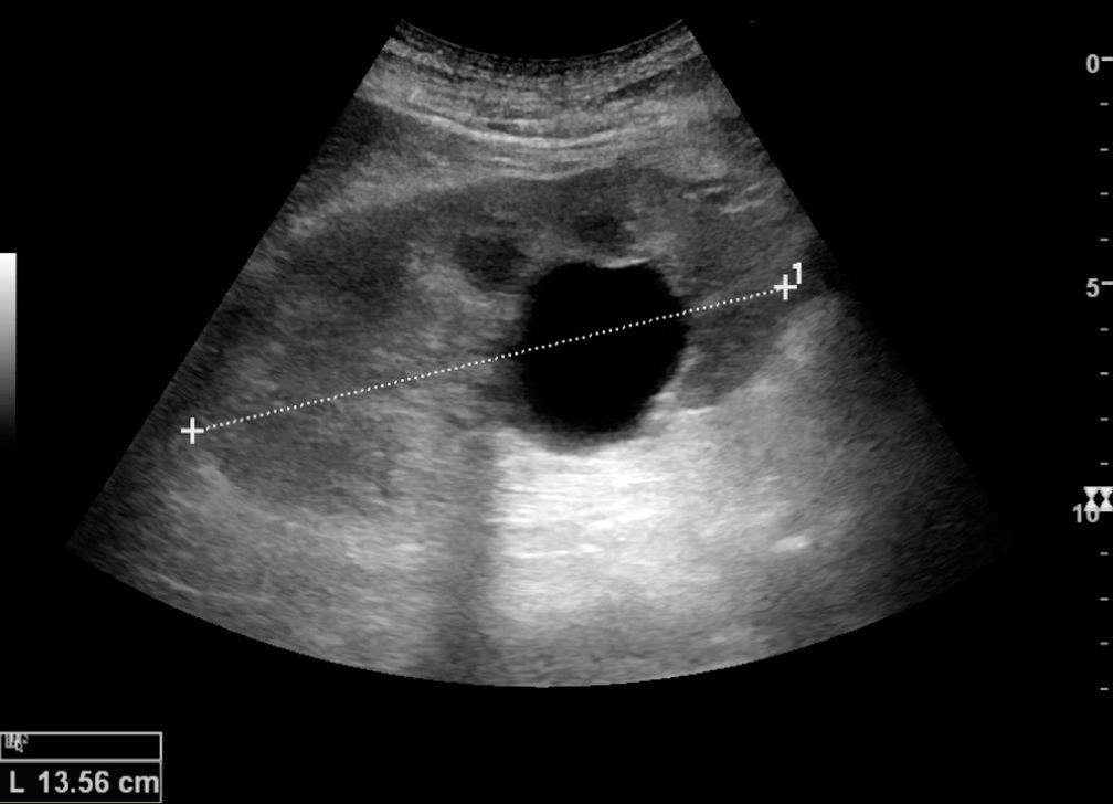 Posterior acoustic enhancement — Sound passes easily through a fluid-filled renal cyst, so the tissue behind it looks brighter than tissue at the same depth.