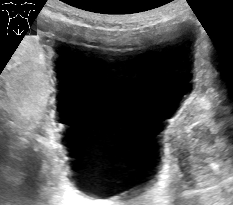 Full urinary bladder — A large, black, urine-filled bladder. The wall is irregular (trabeculated), a sign of chronic urinary retention.