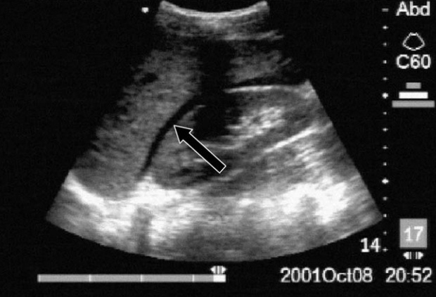 Positive Morison's pouch (RUQ free fluid) — A black (anechoic) stripe of free fluid sits between the liver and the right kidney (arrow). In trauma this is a positive FAST.