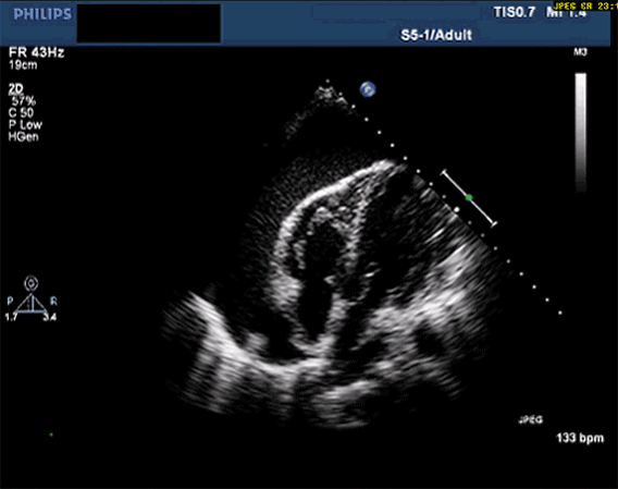 Pericardial effusion with tamponade (apical 4-chamber, animated) — Animated echo of a pericardial effusion causing tamponade; watch the right-sided chambers being compressed during the cardiac cycle.