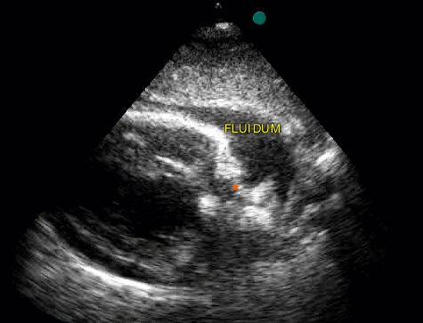 Pericardial effusion, subcostal view (animated) — Subcostal (subxiphoid) view with a black layer of pericardial fluid around the heart; the uploader notes impending right atrial/ventricular tamponade. The word FLUIDUM is burned into the image.