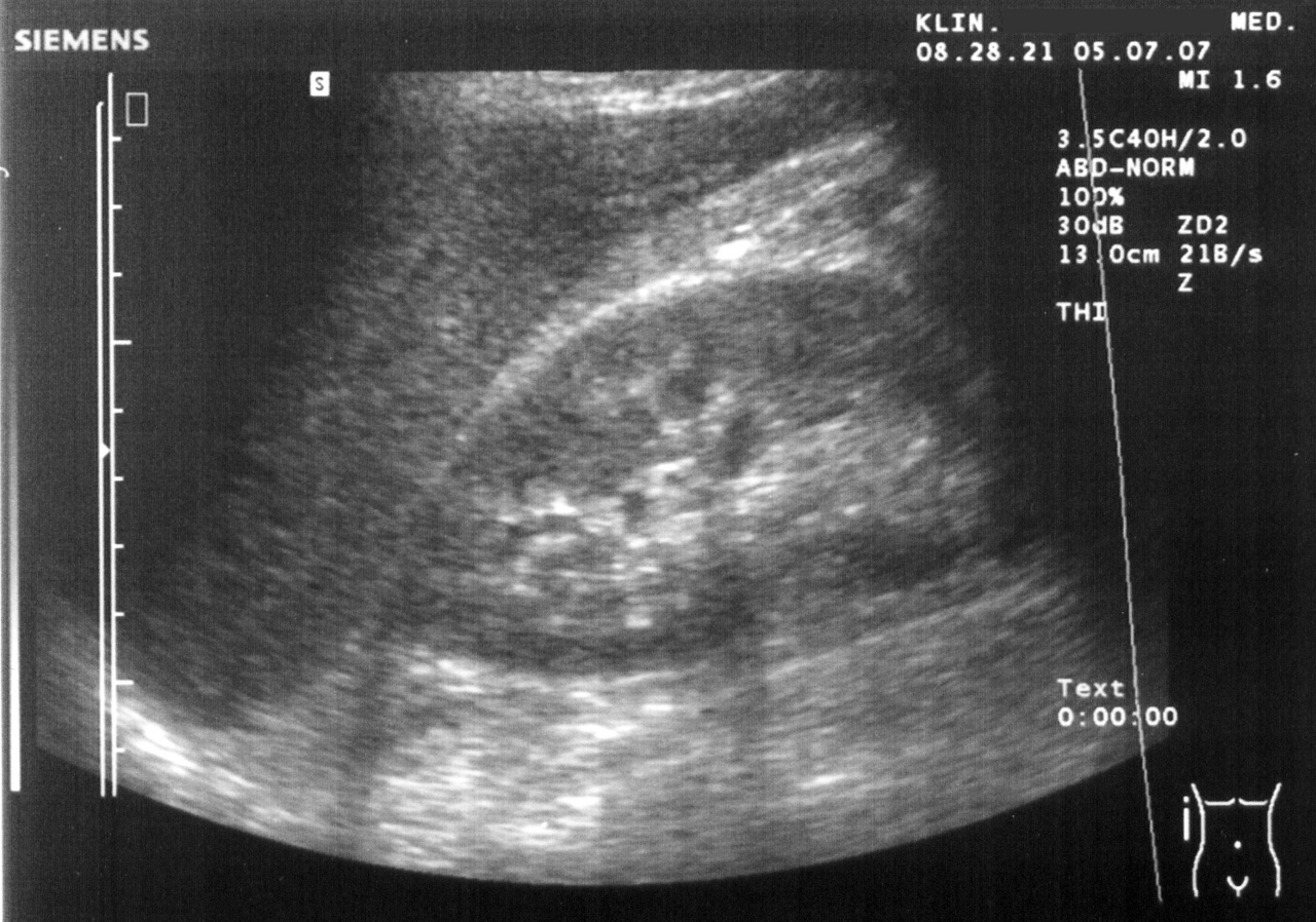 Normal RUQ (Morison's pouch) view — Liver and right kidney touch with no black stripe between them: a negative (normal) RUQ FAST window.