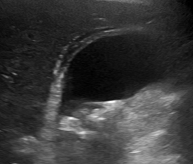 Acute cholecystitis: thick gallbladder wall — Thickened, layered gallbladder wall in a patient with acute abdominal pain; the uploader also reports gallstones and pericholecystic fluid.
