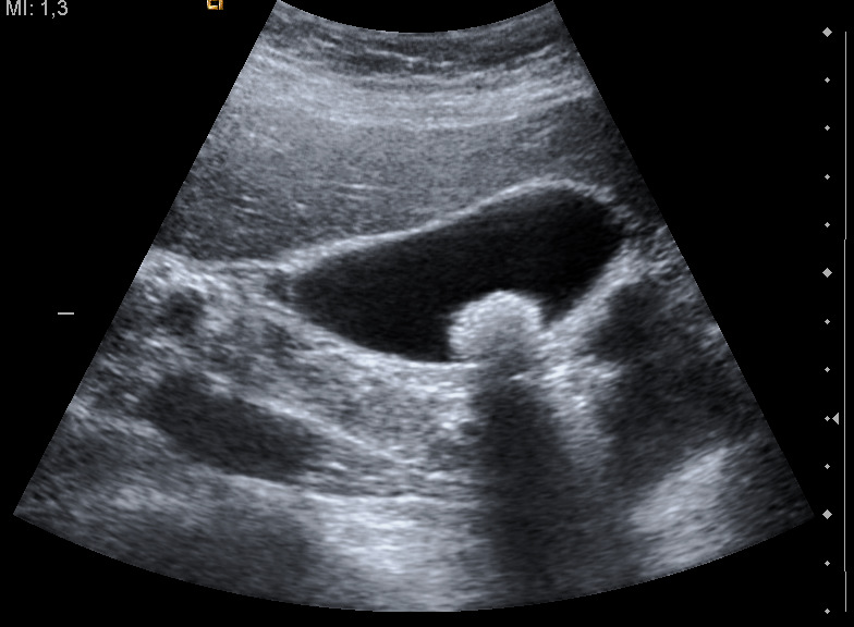 Gallstone with acoustic shadow — A bright stone in the gallbladder casts a black acoustic shadow straight down behind it.