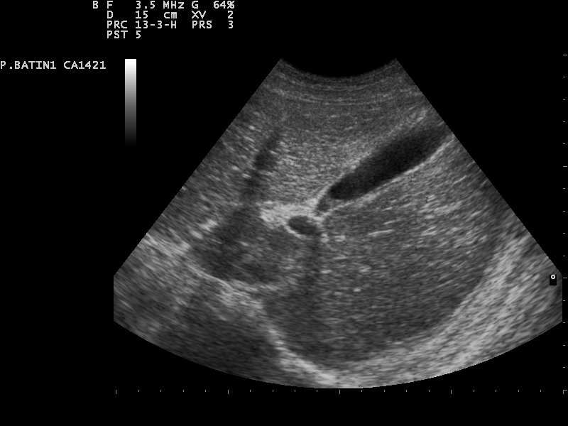 Normal gallbladder — A thin-walled, black (fluid-filled) gallbladder within the liver, with no stones.