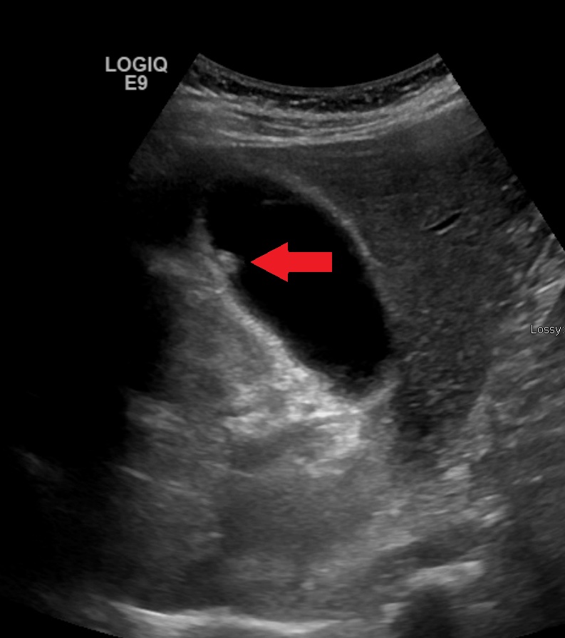 Gallbladder polyp — A small echogenic polyp sticks to the gallbladder wall (red arrow). Unlike a stone, it does not move or cast a shadow.