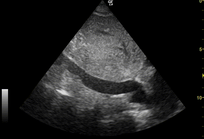 Normal IVC with respiratory variation (animated) — Normal inferior vena cava that gets visibly smaller and larger with breathing. The right heart is seen at the right of the image.