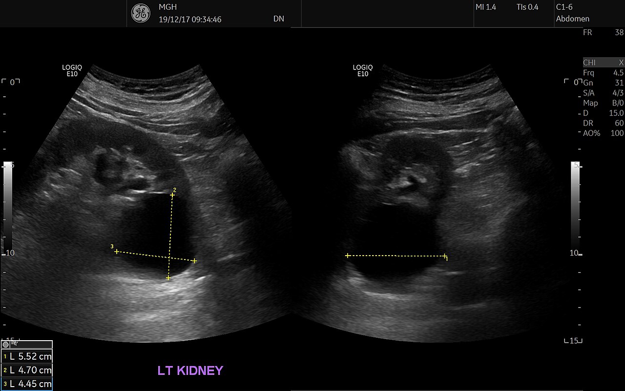Simple renal cyst — A round, black, thin-walled cyst in the left kidney, shown in two planes. Note the brighter area behind it (posterior acoustic enhancement).