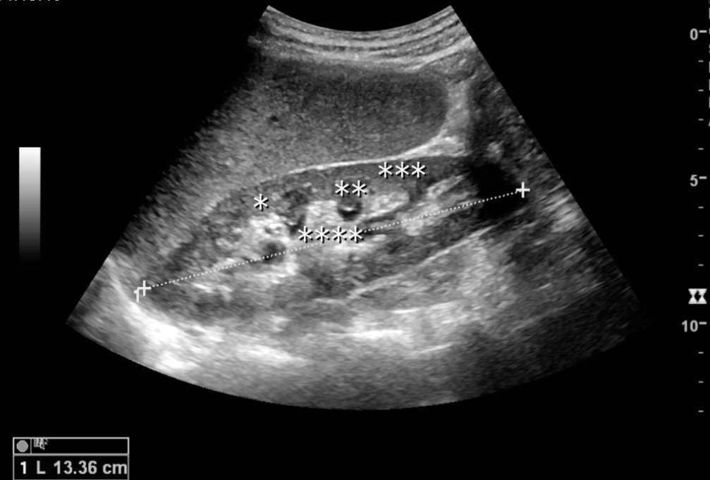 Normal adult kidney — Normal kidney with a grey cortex, darker pyramids and a bright central sinus. Length is measured with calipers.