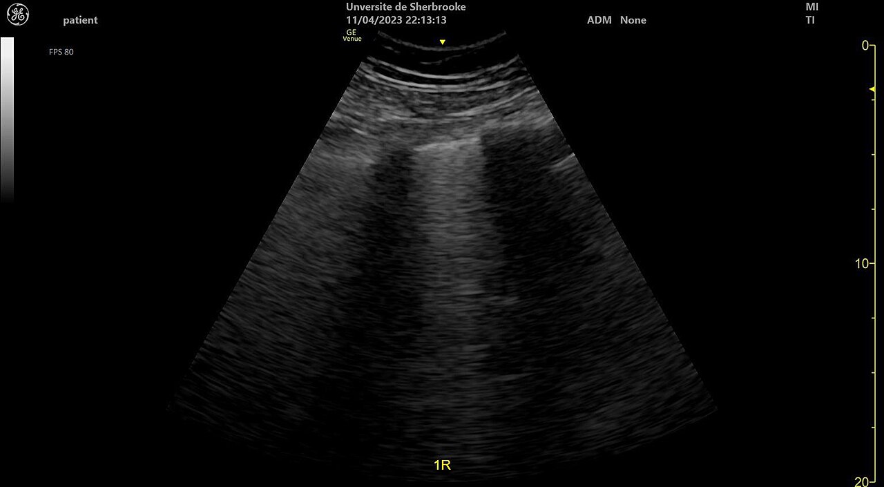 B-lines — Bright vertical bands (B-lines) start at the pleural line and run to the bottom of the screen, wiping out the A-lines. This patient had lung fibrosis.