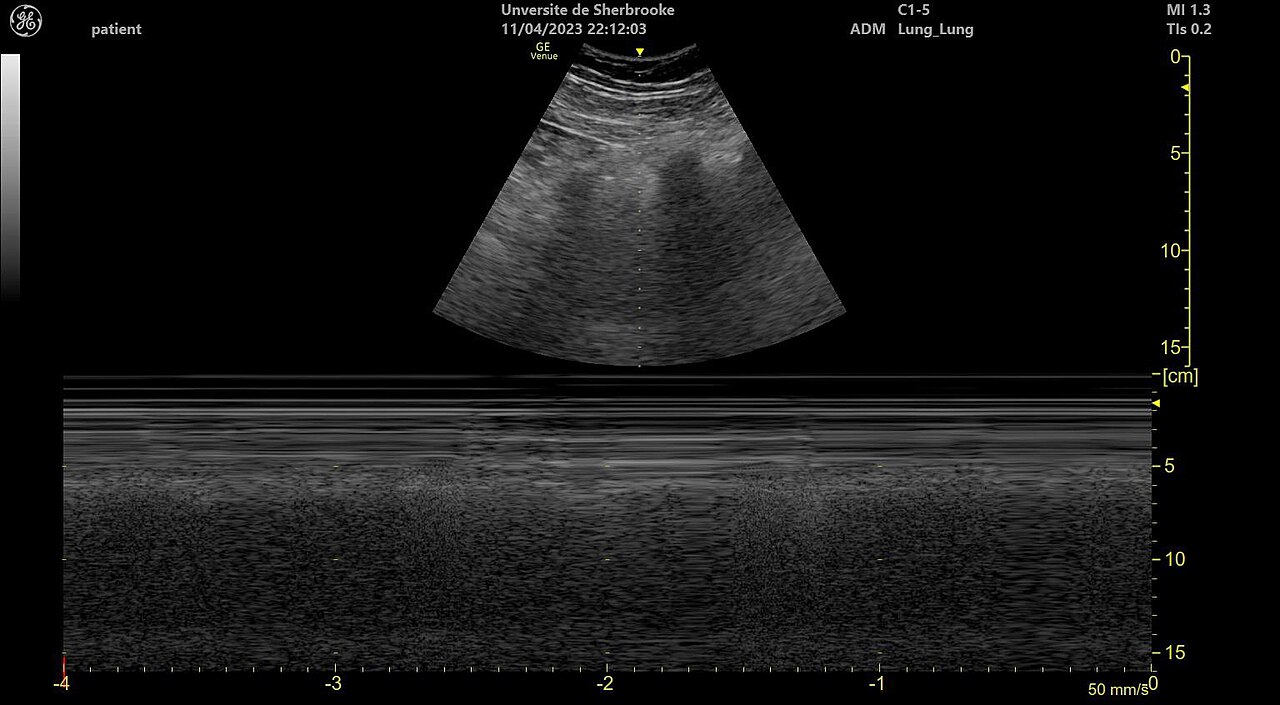 Seashore sign (M-mode) — In M-mode, the motionless chest wall makes straight lines ('waves') and the sliding lung below the pleura makes a grainy 'sand' pattern: normal lung sliding.