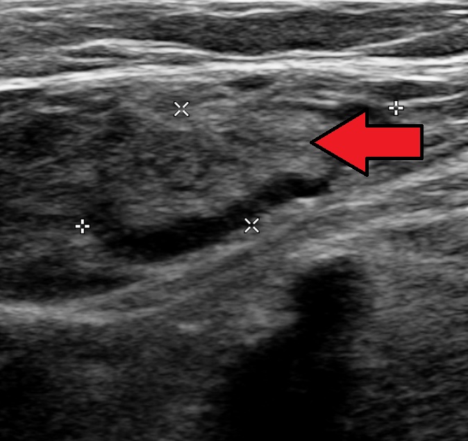 Femoral vein DVT — Echogenic thrombus fills the femoral vein in the groin (arrow); it would not compress with probe pressure.
