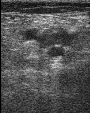 Popliteal vein thrombosis on compression (animated) — Compression ultrasound of the popliteal fossa: the thrombosed popliteal vein does not collapse when pressed. Small image (313 px).